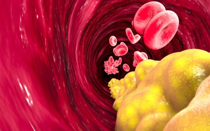 Ανατροπή: Νέα σχέση της «κακής» χοληστερίνης με το εγκεφαλικό